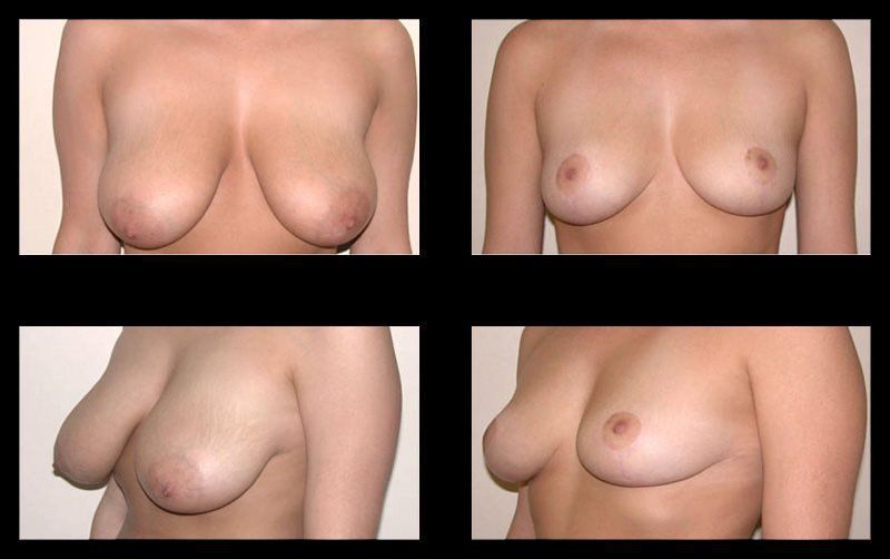 Before & after image of Breast reduction