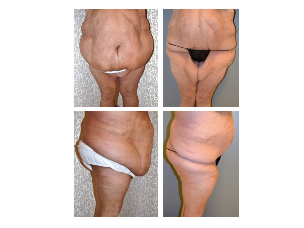 Panniculectomy Before And After Photo Gallery