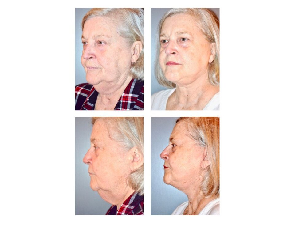 Facelift/Necklift before and after