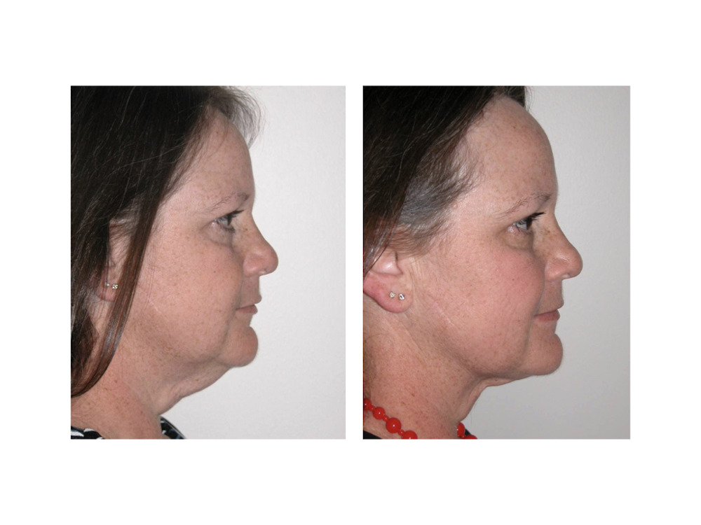 Care Credit Plastic Surgery Reddit / Does Care Credit Pay