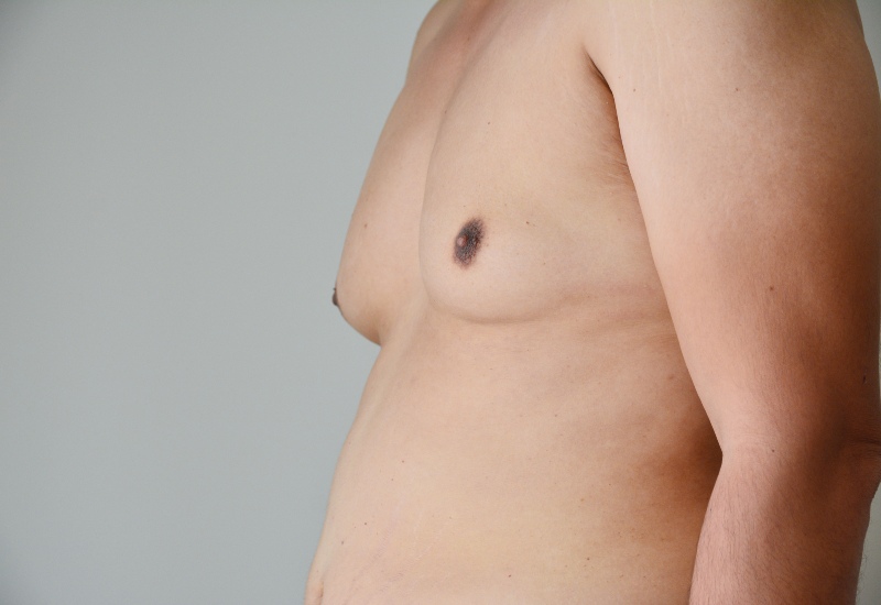 Male Breast Reduction in Jackson, MS