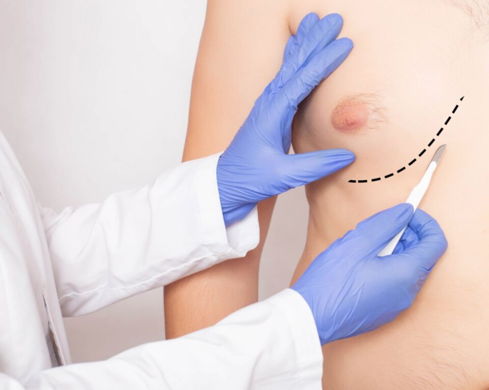 Gynecomastia Treatment in Jackson, MS