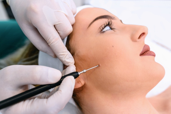 Dermatology procedure removing a facial mole with precision in Jackson, MS
